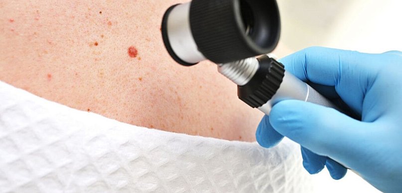 Znamiona skórne – jak ocenić, czy wymagają diagnostyki?