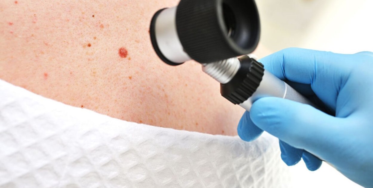 Znamiona skórne – jak ocenić, czy wymagają diagnostyki?